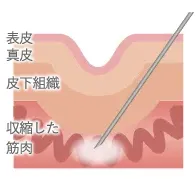 皮膚に刻まれている溝が、シワです。