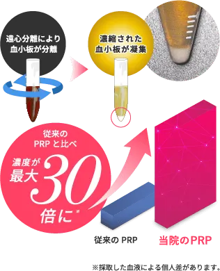 シワ治療のPRP注射に使用するPRPはとにかく濃い！