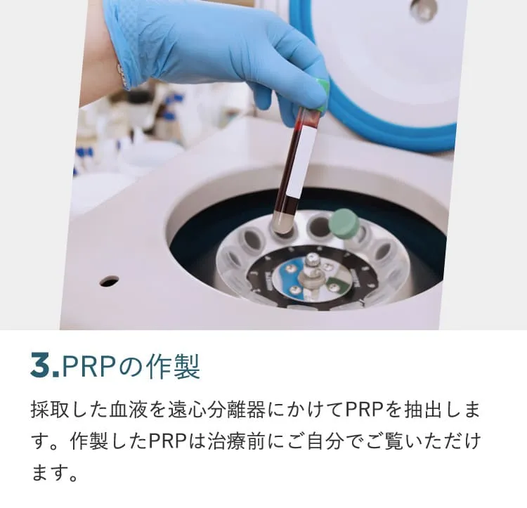 3.PRPの作製