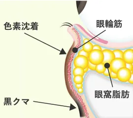 Step 1 目の下のふくらみに加えて、茶クマや黒クマ（影クマ）を伴ったクマ