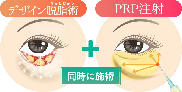 3コンパートメントからまんべんなく脂肪を取る「デザイン脱脂術」と「PRP注射（再生医療）」を組み合わせ、>瞳の存在感を自然に最大化する、画期的な再生治療です。