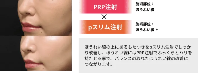 ほうれい線の原因ともなる脂肪のもたつきを改善！